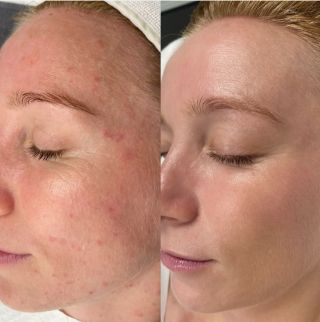 Přirozené výsledky, které mluví samy za sebe🤩 Takhle vypadá pleť, když se spojí profesionální Dermapen ošetření a domácí...