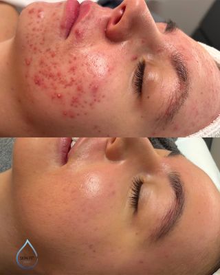 Akné nebolí jen pleť… bolí i sebevědomí. A tento příběh se začal psát dávno před touto fotkou. Eliška k nám přišla tichá,...